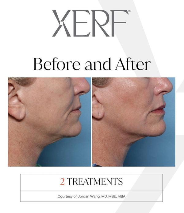 Discover XERF: The Next Generation of Non-Invasive Skin Tightening at PENELOPE & The Beauty Bar
