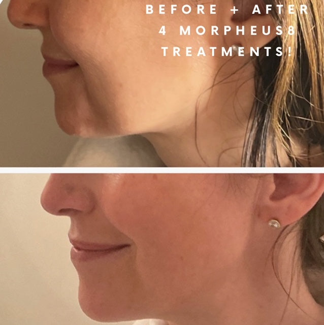 The Morpheus8 Transformation